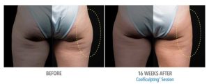 CoolSculpting Before After Pictures in Snellville, GA