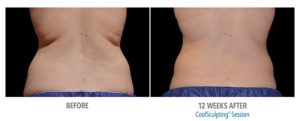 CoolSculpting Before After Pictures in Snellville, GA