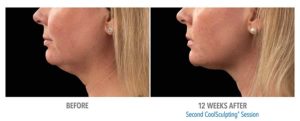 CoolSculpting Before After Pictures in Snellville, GA