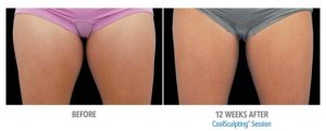 CoolSculpting Before After Pictures in Snellville, GA