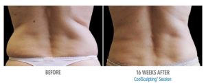 CoolSculpting Before After Pictures in Snellville, GA