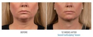 CoolSculpting Before After Pictures in Snellville, GA