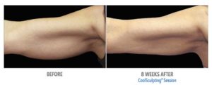 CoolSculpting Before After Pictures in Snellville, GA