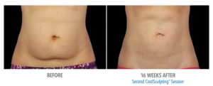 CoolSculpting Before After Pictures in Snellville, GA