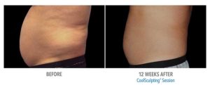 CoolSculpting Before After Pictures in Snellville, GA