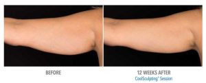 CoolSculpting Before After Pictures in Snellville, GA