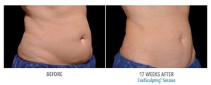 CoolSculpting Before After Pictures in Snellville, GA