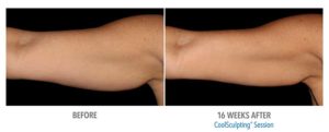 CoolSculpting Before After Pictures in Snellville, GA