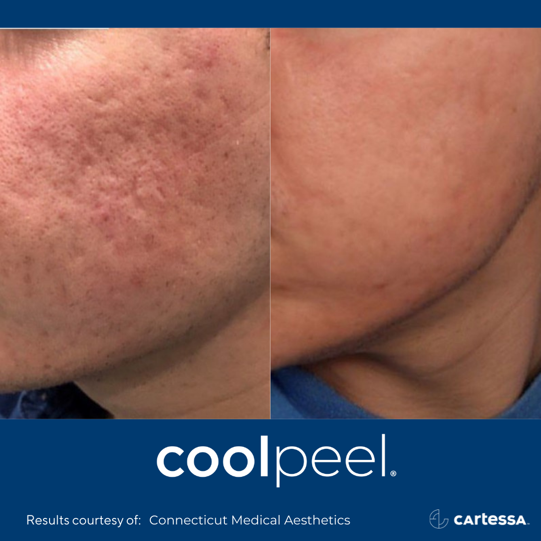 CoolPeel® in Snellville, GA