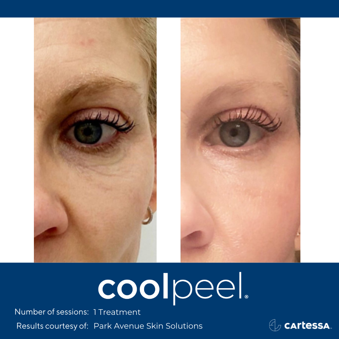 CoolPeel® in Snellville, GA