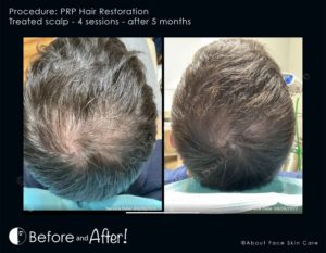 PRP Hair Restoration Before and After Pictures Snellville and Dacula, GA