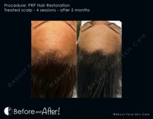 PRP Hair Restoration Before and After Pictures Snellville and Dacula, GA