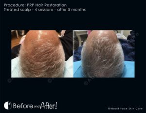 PRP Hair Restoration Before and After Pictures Snellville and Dacula, GA