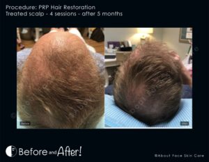 PRP Hair Restoration Before and After Pictures Snellville and Dacula, GA