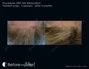 PRP Hair Restoration Before and After Pictures Snellville and Dacula, GA