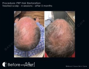 PRP Hair Restoration Before and After Pictures Snellville and Dacula, GA