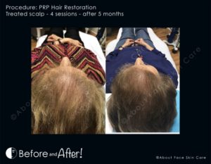 PRP Hair Restoration Before and After Pictures Snellville and Dacula, GA