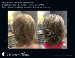 PRP Hair Restoration Before and After Pictures Snellville and Dacula, GA