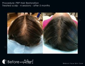 PRP Hair Restoration Before and After Pictures Snellville and Dacula, GA