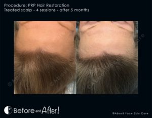 PRP Hair Restoration Before and After Pictures Snellville and Dacula, GA