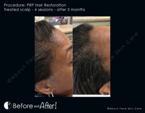 PRP Hair Restoration Before and After Pictures Snellville and Dacula, GA