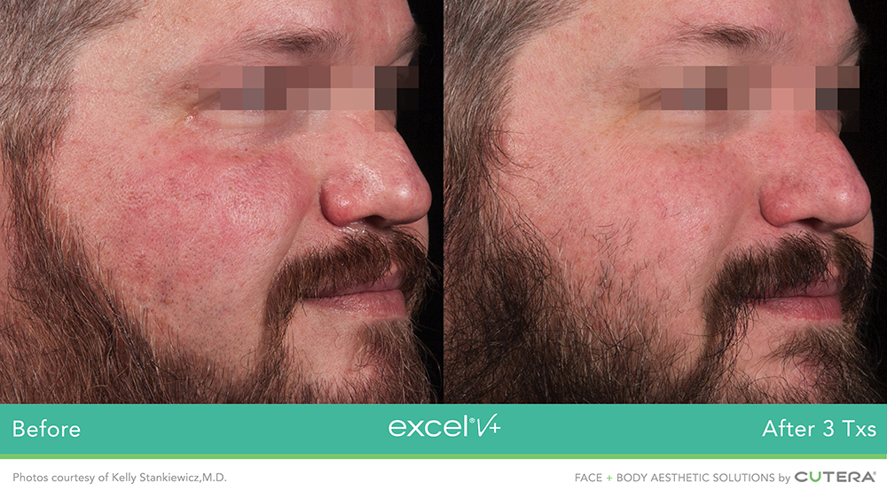 Excel V+ by Cutera® Before and After Pictures Snellville and Dacula, GA